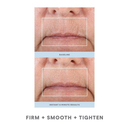 NuFace Fix uređaj za uklanjanje finih linija i bora