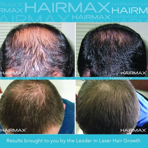 Hairmax Ultima 9 laserski češalj za poticanje rasta kose