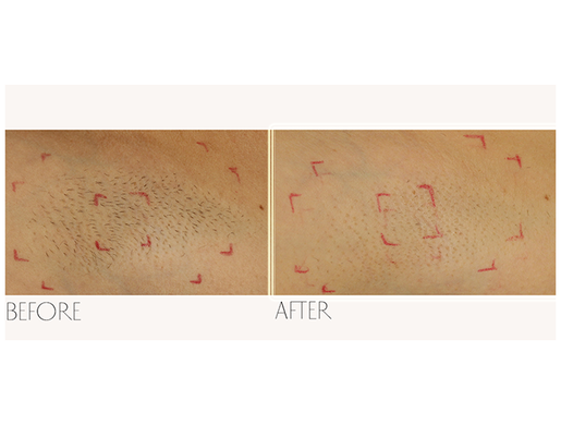 SmoothSkin Bare + IPL odstranjivač dlačica crni